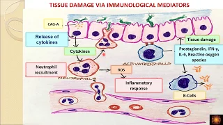 Chronic H Pylori gastritis - Dr.V.Shanthi