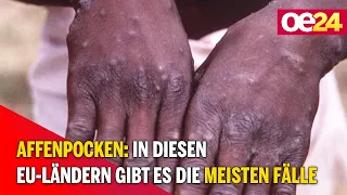 Affenpocken: In diesen EU-Ländern gibt es die meisten Fälle