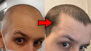 SEVERE Hair Loss Return From The Dead With The Big 3