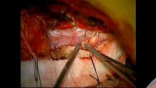 Far lateral craniotomy foramen magnum meningioma