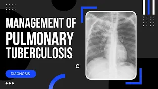 Pulmonary Tuberculosis