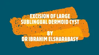 Excision of Large Sublingual Dermoid Cyst