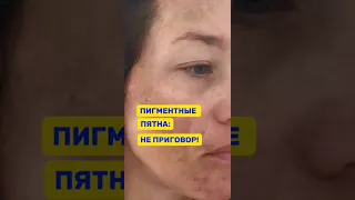 Как убрать пигментные пятна на всегда .Пигментация #пигментация #печеночныепятна #пятнаналице