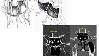 ANATOMICAL VARIATIONS IN SINONASAL REGION (CT SCAN OVERVIEW)