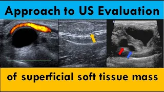 Approach to ultrasound evaluation of superficial soft tissue mass