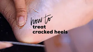 DIY PEDICURE FOR CRACKED HEELS | How to Treat Cracked Heels At Home