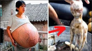 15 Most Unusual Pregnancies In History