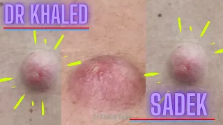 Massive Back Cyst. Dr Khaled Sadek. LipomaCyst.com