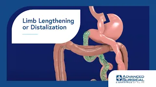 Gastric Bypass Revision with Limb Lengthening/Distalization