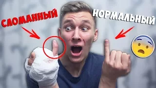 СЛОМАЛ ПАЛЕЦ! МЕНЯ КЛАДУТ НА ОПЕРАЦИЮ! *ЭТО НЕ ПРАНК* МНЕ СТРАШНО! КАК Я ПОПАЛ В БОЛЬНИЦУ! БпС