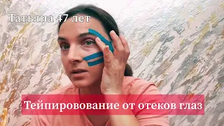 Тейпирование от отёков глаз