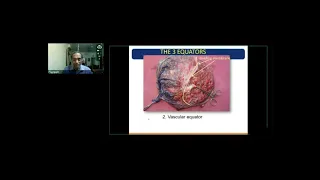 GE Webinar on Monochorionic Twins by Dr S Suresh