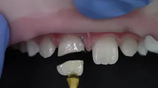 Tooth fractured? Reattach it.