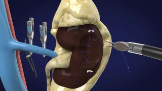 Partial Nephrectomy