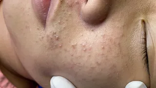 Blackhead, Acne P1 (Nghia) | Mụn Đầu Đen, Mụn Trứng Cá P1 (Nghĩa) - SacDepSpa#325