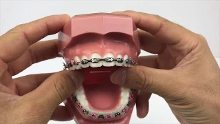 How Do Braces Close Gaps Between Teeth 2018