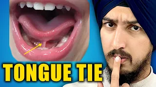 If You Have a Tongue Tie WATCH THIS