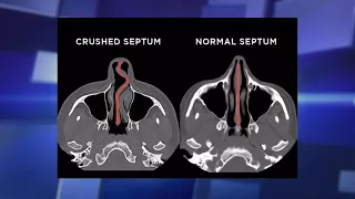 Worst Deviated Septum This Plastic Surgeon Has Ever Seen