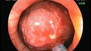 Polypectomy for large sigmoid colonic polyp