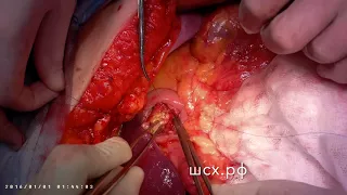 Панкреато-гастроанастомоз (Pancreato-gastrostomy)