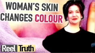 Woman's Skin Starts To CHANGE COLOUR (Mystery Diagnosis) | Medical Documentary | Reel Truth