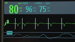 Non-Invasive Transcutaneous Pacing with the Efficia DFM100 monitor/defibrillator