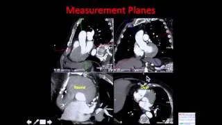 Pre-Operative CT Evaluation of TAVR