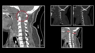 Spinal Trauma | Interesting Radiology Cases