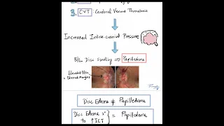 The 3 Important Causes of Papilledema #Shorts