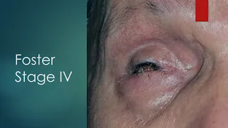 Cicatrising Conjunctivitis; Ocular Cicatricial Pemphigoid & Stevens Johnson Syndrome