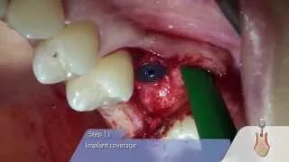 OT medical: OT-F3 Implant-Insertion with Sinus Lift-Osteotomy