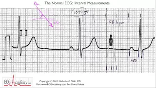 Interval Measurements 6-4 - ECG / EKG Interpretation -- BASIC