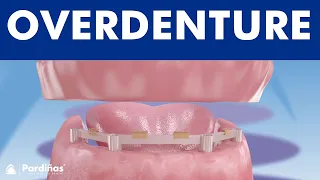 Overdenture with dental implants ©
