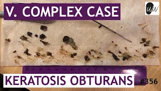 V. COMPLEX CASE: Keratosis Obturans Removal - #356