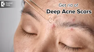Treatment of depressed Acne Scars|Deep Pitted Acne| Pimple Pits -Dr.Rajdeep Mysore | Doctors' Circle