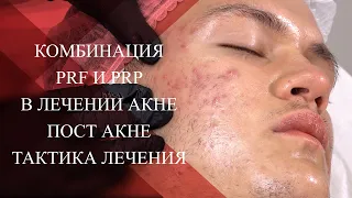 💉Комбинация PRF PRP в лечении АКНЕ | ПОСТ АКНЕ |Тактика лечения