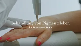 Behandlung von Pigmentflecken bei Dermacare Wien