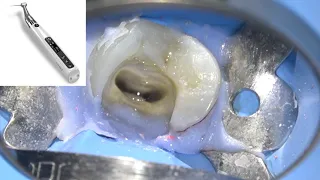 Retreatment with Eighteeth Endo Device by Dr. Jose Conde Pais