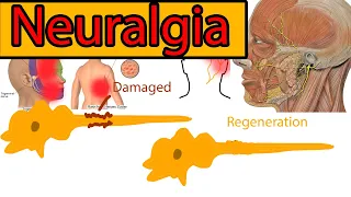 Neuralgia- Explained under 3 minutes. Trigeminal Neuralgia symptoms and treatment