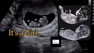 it's a baby girl 🤱by 'Nub Theory' !! Ultrasound