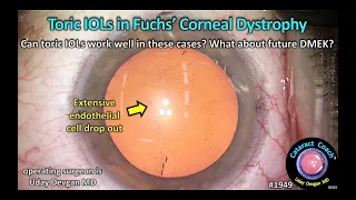 CataractCoach™ 1949: toric IOLs in Fuchs' corneal dystrophy