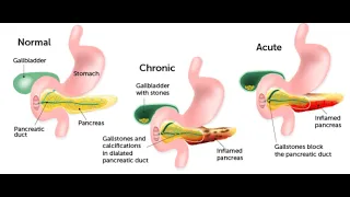 Pancreatitis : Explained