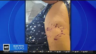 Dallas County woman thankful to be alive after dog attack; owner faces felony