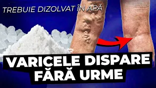 Acest remediu s a UITAT! Cel mai bun ucigaș de Varice, Edeme, Dureri de Picioare și Oboseală!