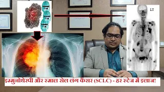 Small cell lung cancer - DM(AIIMS) - Stage 3 stage 4 lung cancer medicine in hindi 2020