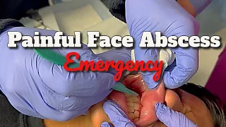 We Drain a Painful Facial Abscess in a Teenager