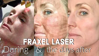 My FRACTIONAL CO2 LASER Experience | The FULL Treatment & the DAYS following | BEFORE & AFTER Fraxel