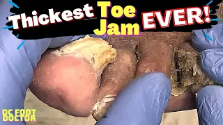 Thickest Toe Jam Ever! Big Build-up Between The Toes and Fungal Toenails