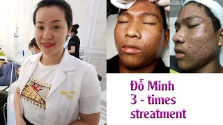 Acne treatment reputation, effective at Hien Van Spa|375|Đỗ Minh-3 times