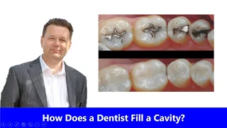 How Does a Dentist Fill a Cavity?